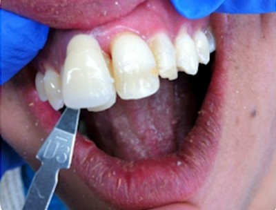 Porcelain bonded crown with close colour match