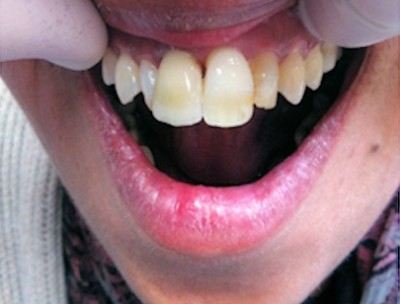 Staining on the natural teeth has been closely imitated in the crown