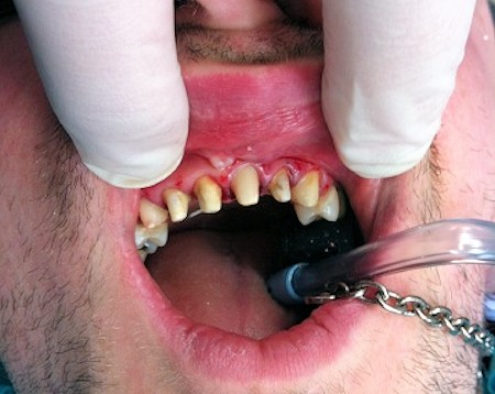 Teeth reshaped and prepared