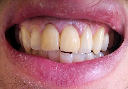 Temporary Crowns fitted